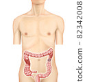 Illustration material: Descending colon cancer 001 (real) 82342008