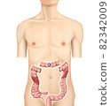 Illustration material: Transverse colon cancer 002 (real) 82342009