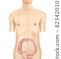 Illustration material: Transverse colon cancer 003 (real) 82342010