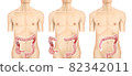 Illustration material: Right colon cancer 004 (real) 82342011