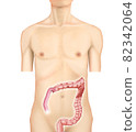 Illustration material: Right colon cancer 003 (real) 82342064