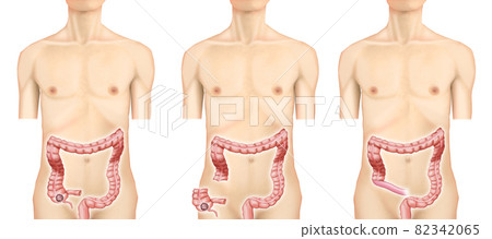 插圖素材：盲腸癌004（實物） 82342065