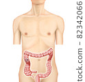 Illustration material: Right colon cancer 001 (real) 82342066