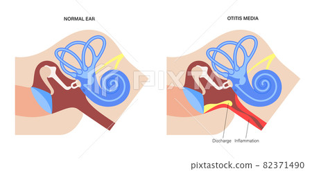 otitis media disease otitis media disease 82371490