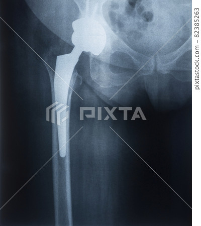 X-ray of a prosthesis of a female hip joint. Joint endoprosthetics 82385263