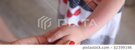 Sunburn redness and peeling of skin on child hand closeup 82399196