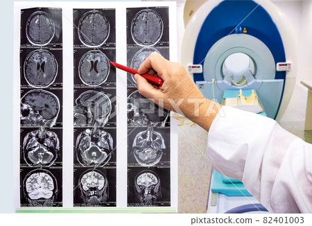 magnetic resonance image or MRI of the brain magnetic resonance image or MRI of the brain 82401003