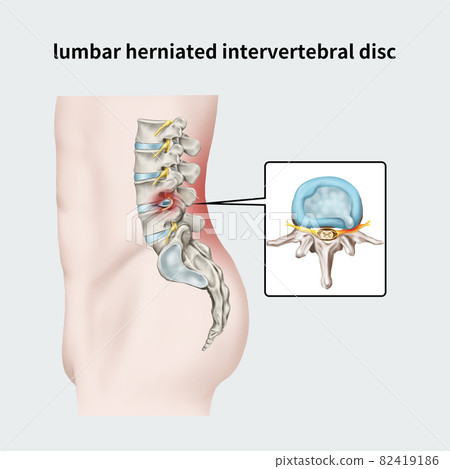 疾病 腰 痛苦 82419186