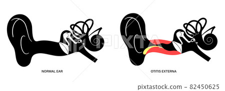 Swimmers ear otitis 82450625