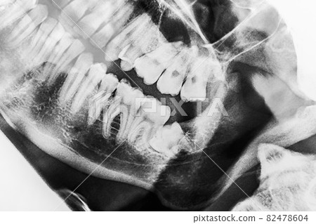 X-ray scan picture of wisdom teeth dentistry close-up 82478604