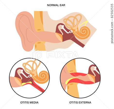 Externa media otitis Externa media otitis 82502535