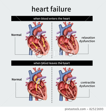 heart failure - Stock Illustration [82521693] - PIXTA