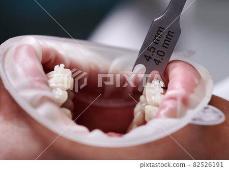 Close up of dentist using aluminum bracket gauge while attaching braces to patient teeth. Person with cheek retractor in mouth and orthodontic brackets on teeth receiving treatment in clinic. 82526191