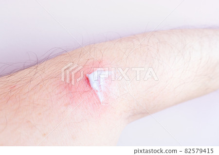 A photo of a man's arm swollen red. Image of dermatitis / skin disease. Apply an ointment. 82579415