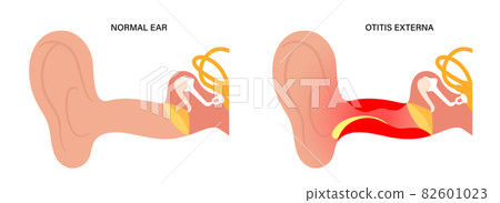 Swimmers ear otitis 82601023