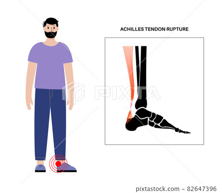 Achilles tendon injury 82647396