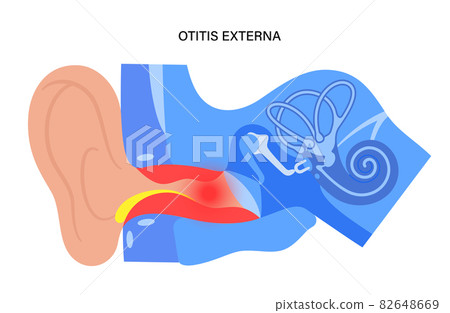 Swimmers ear otitis Swimmers ear otitis 82648669
