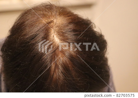 Women's thinning hair, scalp Women's thinning hair, scalp 82703575