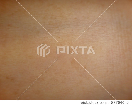 Rough skin surface 82704032