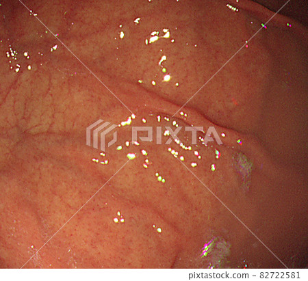 Gastroscope 82722581