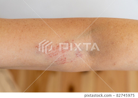 Scratches on the upper arm that fell and rubbed 82745975