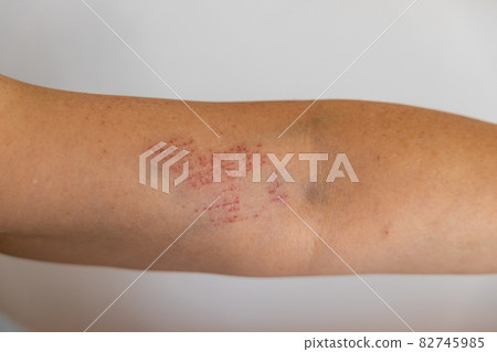 Scratches on the upper arm that fell and rubbed 82745985