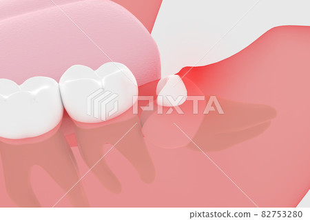 Partially exposed wisdom tooth 3D rendering Partially exposed wisdom tooth 3D rendering 82753280