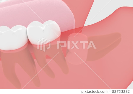 埋在牙齦中的智齒 3D 渲染 82753282