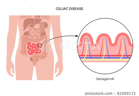 Celiac disease inflammation 82809115