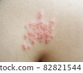 skin disease shingles 82821544