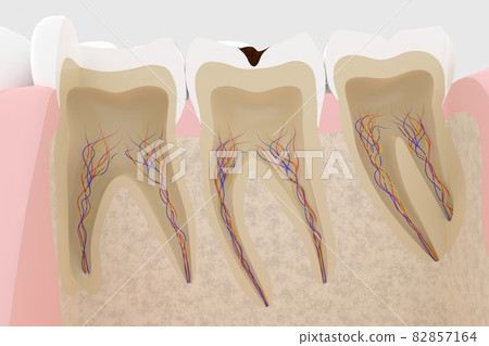 3D rendering of a cross section of a tooth with cavities 82857164