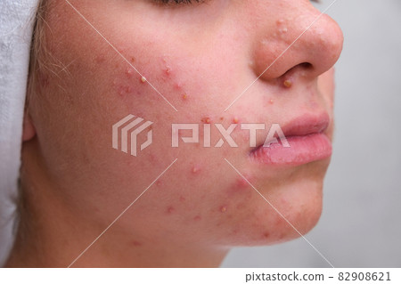 Acne. Teenage girl with the pimples on her face. Problematic skin. Close-up. 82908621