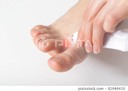 The girl applies a healing ointment between the toes against fungus and sweating of the feet, close-up, dermatology The girl applies a healing ointment between the toes against fungus and sweating of the feet, close-up, dermatology 82946410