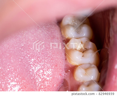 Caries in the mouth on the chewing teeth. Installation of high quality dental fillings. Dental treatment in modern dentistry, macro 82946939