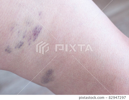 Bruises and thrombosis on the legs of a woman. Phlebeurysm, close-up, chronic Bruises and thrombosis on the legs of a woman. Phlebeurysm, close-up, chronic 82947297