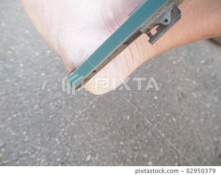 How to scrape the keratin of the heel 82950379