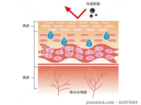 Atopic dermatitis 82955004