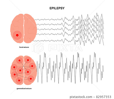 epilepsy seizure concept 82957353