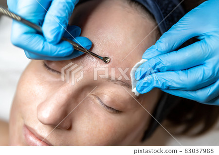 Close-up detail of beautician doctor hand in blue rubber protective gloves make blackhead spot pimples removal procedure for young adult female patient. Woman facial cleansing and skin care concept 83037988