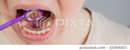 Close-up portrait of a woman with internal braces and a dental mirror. The girl corrects the bite Close-up portrait of a woman with internal braces and a dental mirror. The girl corrects the bite 83064803