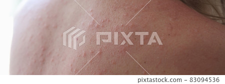 Woman injured back with rash and red sun spots 83094536