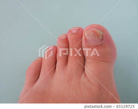 onychomycosis with toenail fungal infection on light background. Five toes of the left foot of a white woman. The effect of the treatment is noticeable on the thumbnail. Regrowth of a healthy nail onychomycosis with toenail fungal infection on light background. Five toes of the left foot of a white woman. The effect of the treatment is noticeable on the thumbnail. Regrowth of a healthy nail 83129725