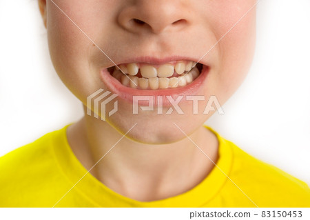Little girl stands on a white background with a beautiful smile, children crooked teeth, pediatric dentistry. Crooked teeth close-up. Correction of malocclusion is required. Little girl stands on a white background with a beautiful smile, children crooked teeth, pediatric dentistry. Crooked teeth close-up. Correction of malocclusion is required. 83150453