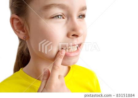 Little girl stands on a white background with a beautiful smile, children crooked teeth, pediatric dentistry. Crooked teeth close-up. Correction of malocclusion is required. 83151884