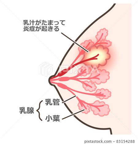 乳腺炎的插圖與解釋 83154288
