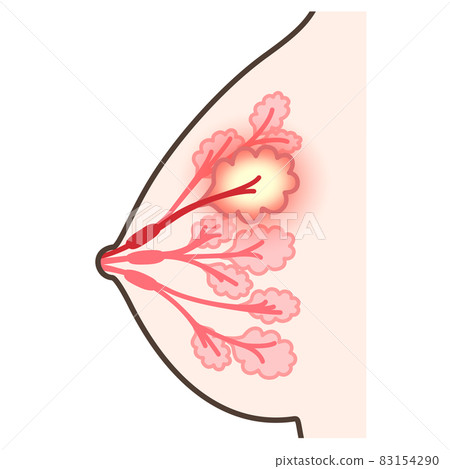 Illustration of mastitis 83154290