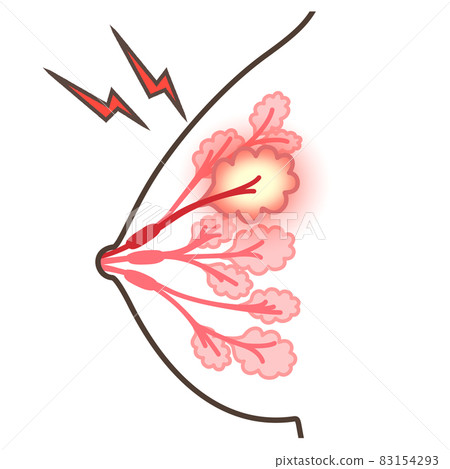 Illustration of mastitis 83154293