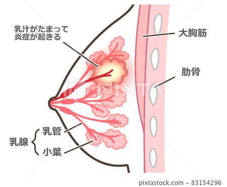 Illustration of mastitis with explanation 83154296