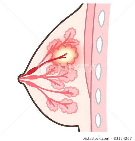 Illustration of mastitis 83154297