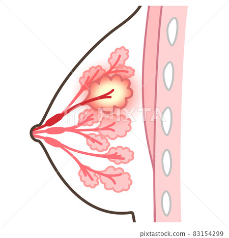 Illustration of mastitis 83154299